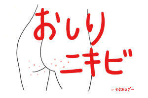 【おしりのニキビ】解消してつるんとしたヒップを目指す方法（簡単1ステップ）